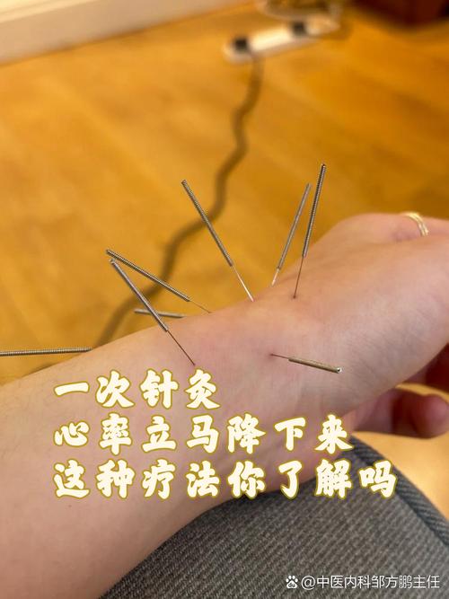 王文远平衡针灸穴位图