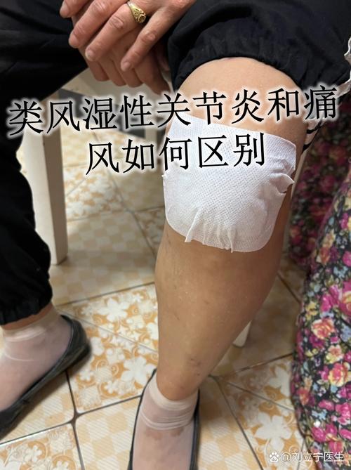 有风湿类风湿能正骨吗