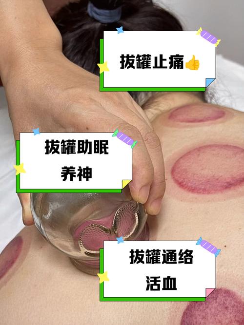 拔罐减肥拔哪个穴位啊