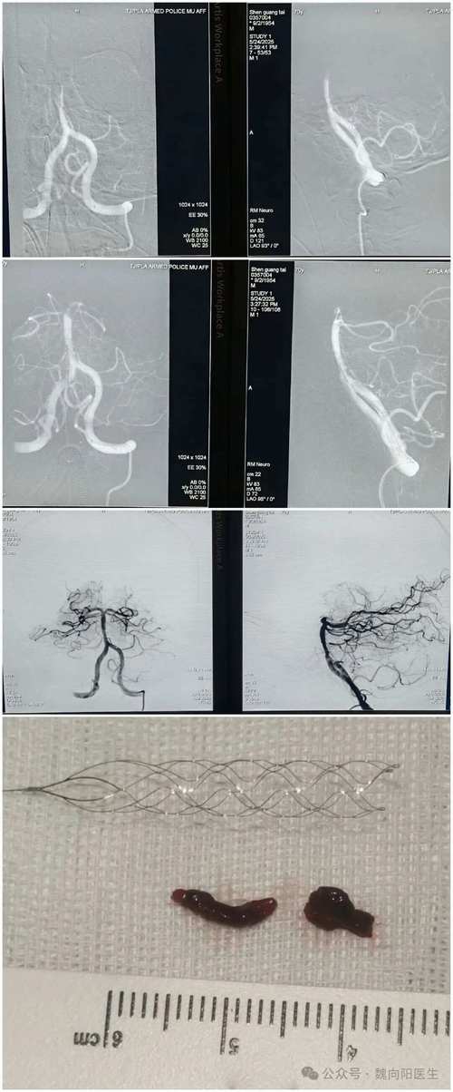 脑梗 昏迷 基底动脉