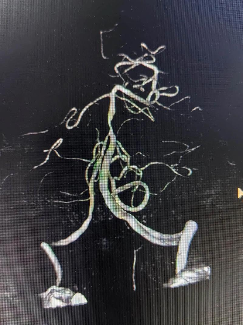 脑梗 昏迷 基底动脉