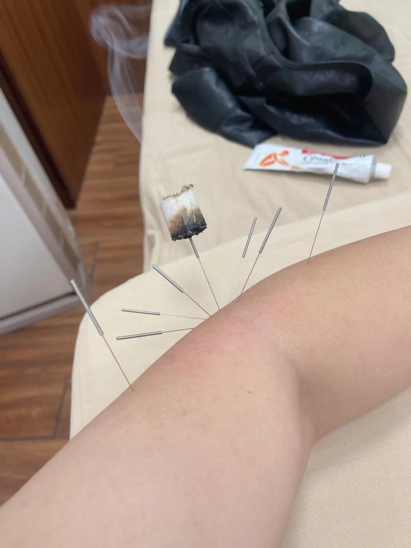 肱骨外上髁炎针灸穴位