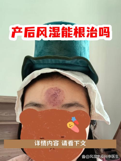 产后风湿能当风湿治吗