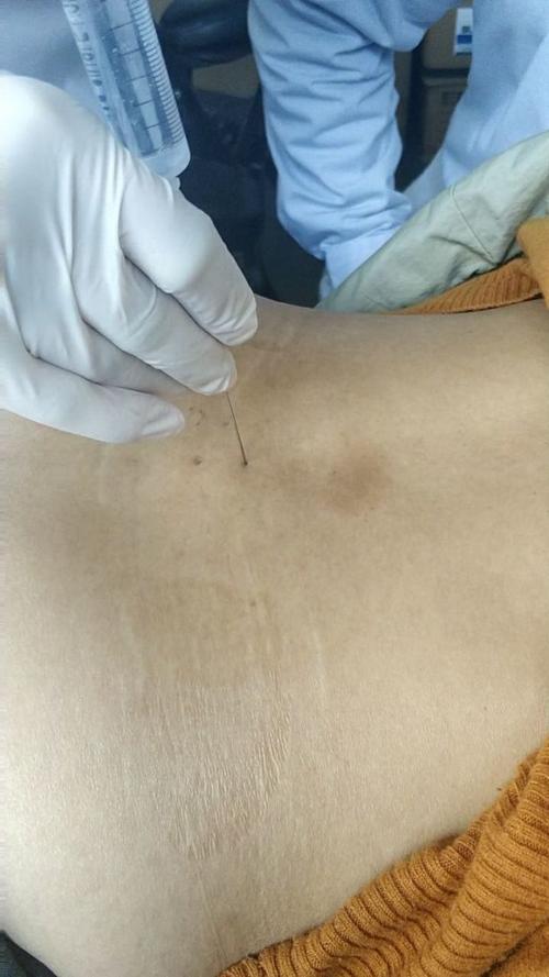 南阳风湿类风湿水针刀