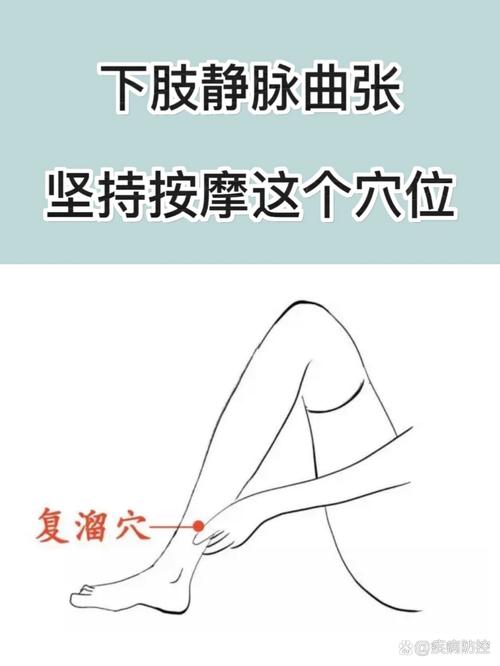 那个穴位对静脉曲张好