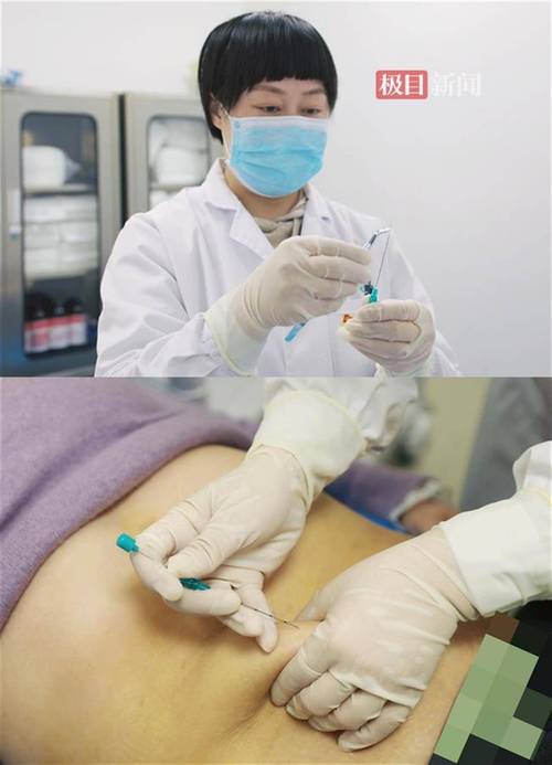 穴位埋线真的能减肥吗