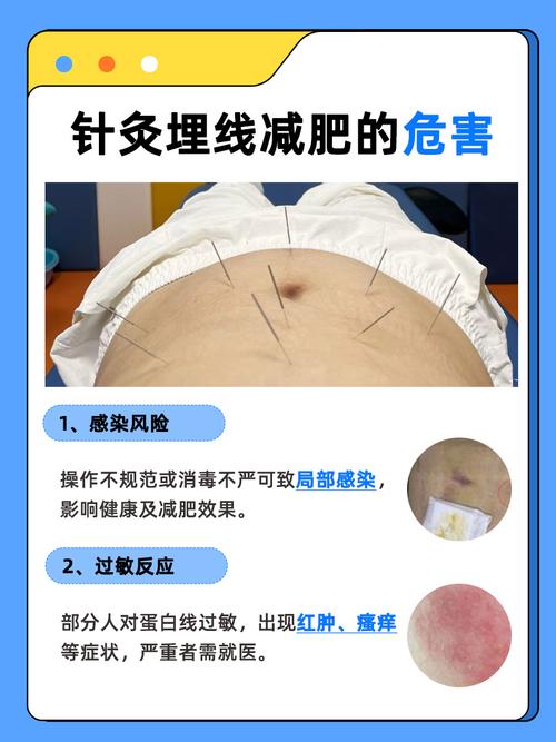 穴位埋线真的能减肥吗