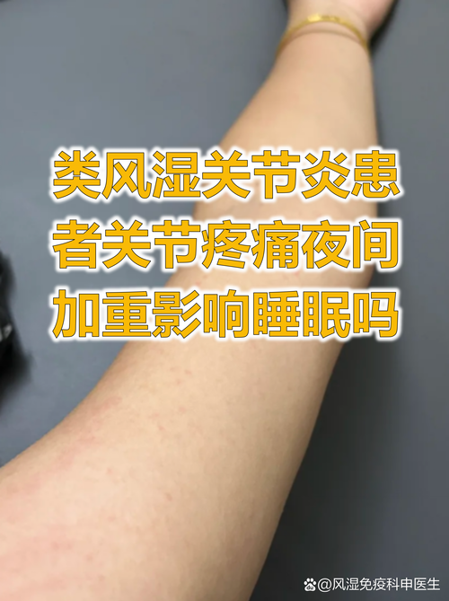 临泉中医院风湿类风湿