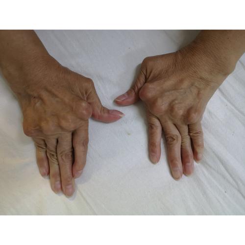 风湿关节炎转成类风湿