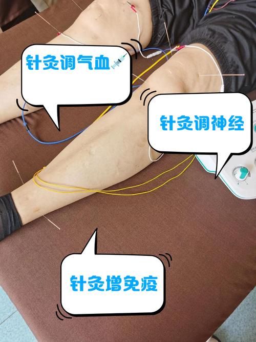 打穴位针有什么副作用