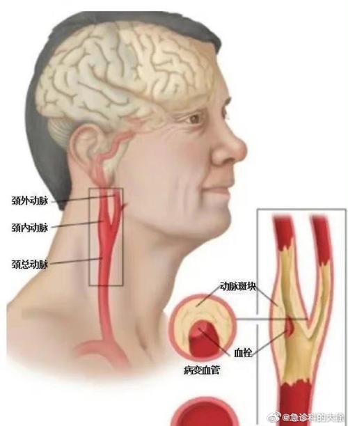 动脉硬化引发脑梗心梗