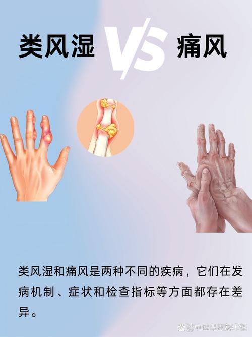 风湿骨痛是不是风湿呢