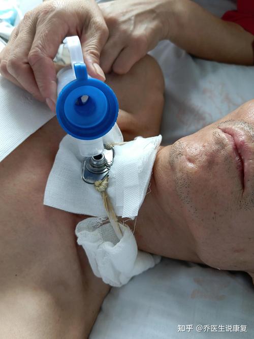 脑梗 发烧 气管切开