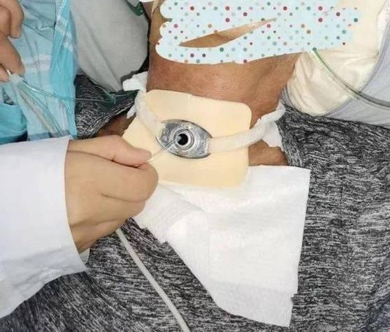 脑梗 发烧 气管切开