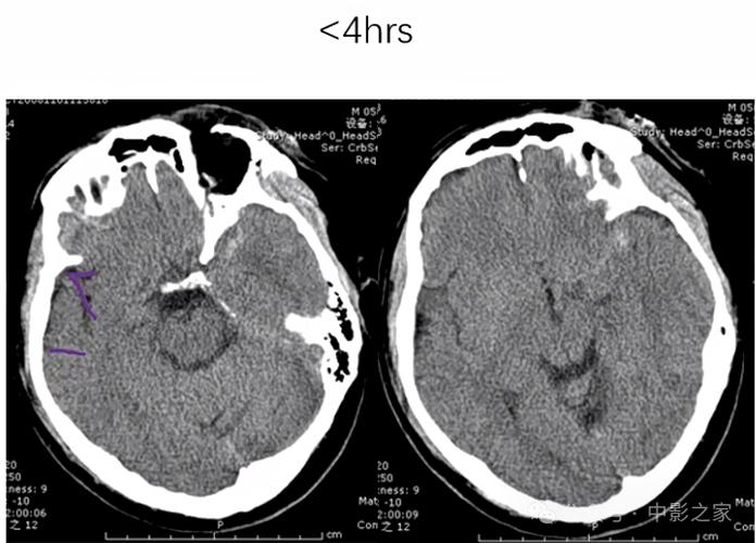 脑CT怎么看急性脑梗