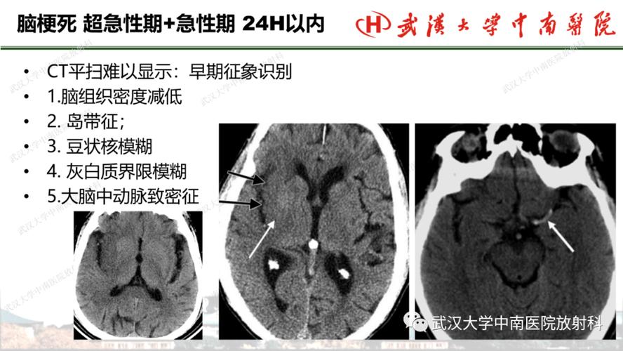脑CT怎么看急性脑梗