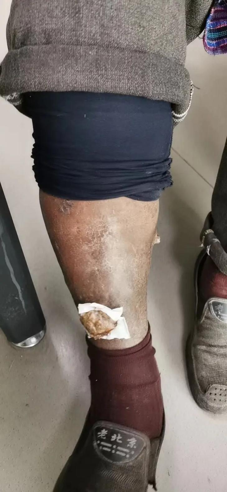 脑梗心梗老人腿溃烂啦