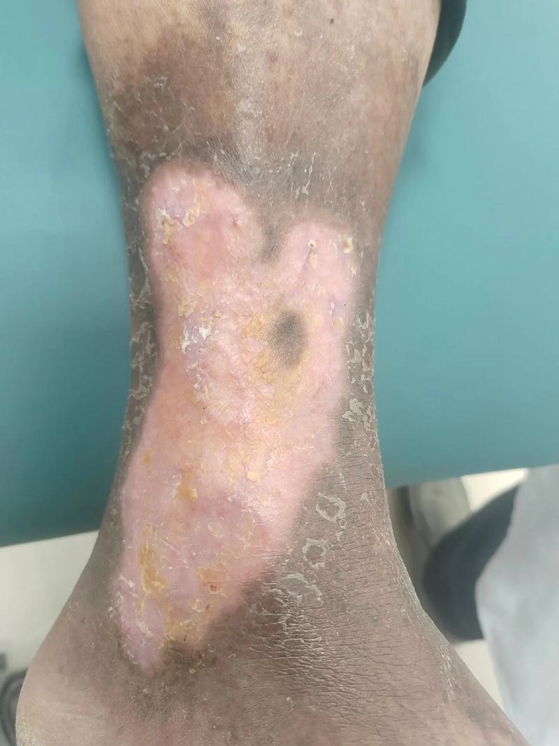 脑梗心梗老人腿溃烂啦