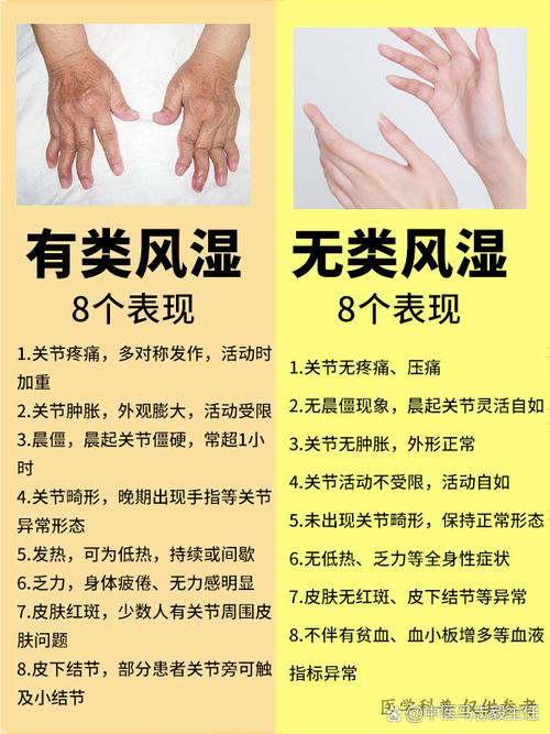 风湿和累风湿哪个好治