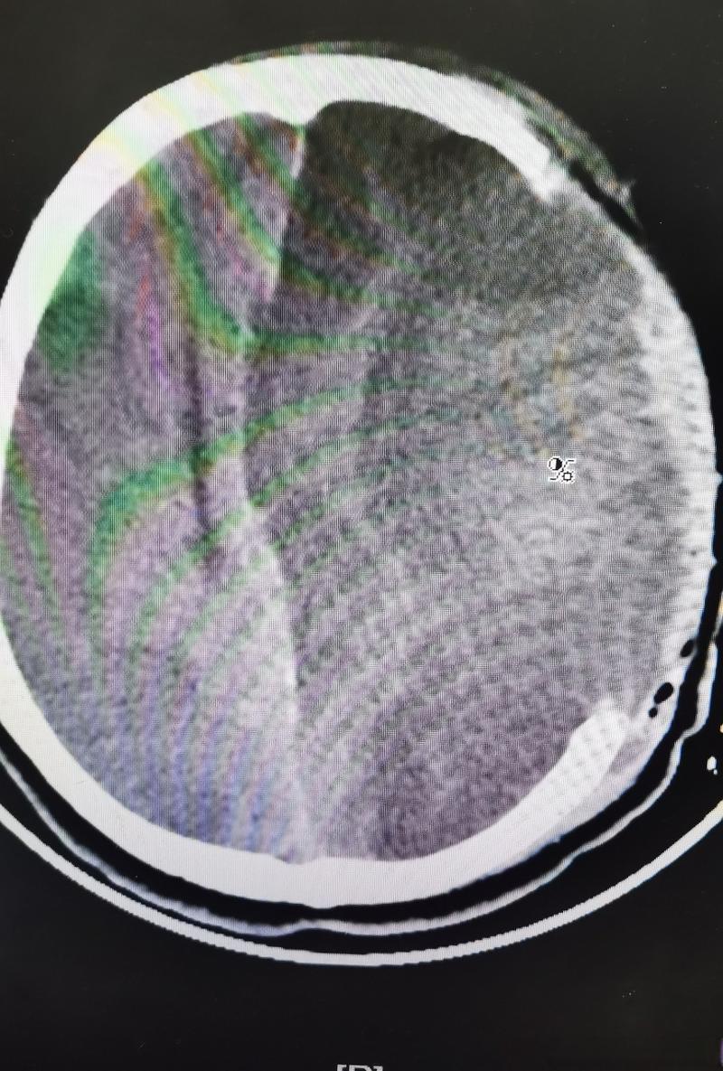 脑梗后脑水肿轻度脑疝