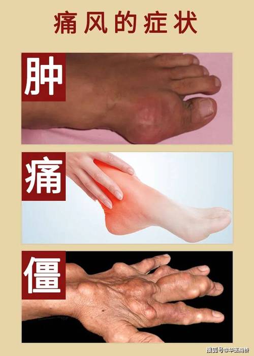风湿类风湿痛风的症状