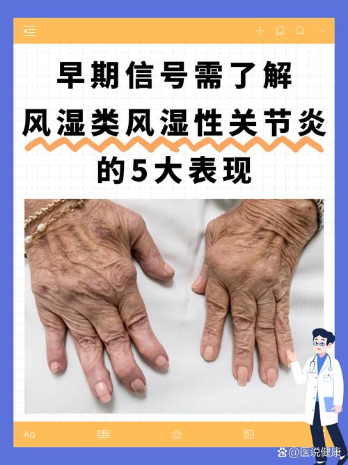 产后风湿和类风湿症状