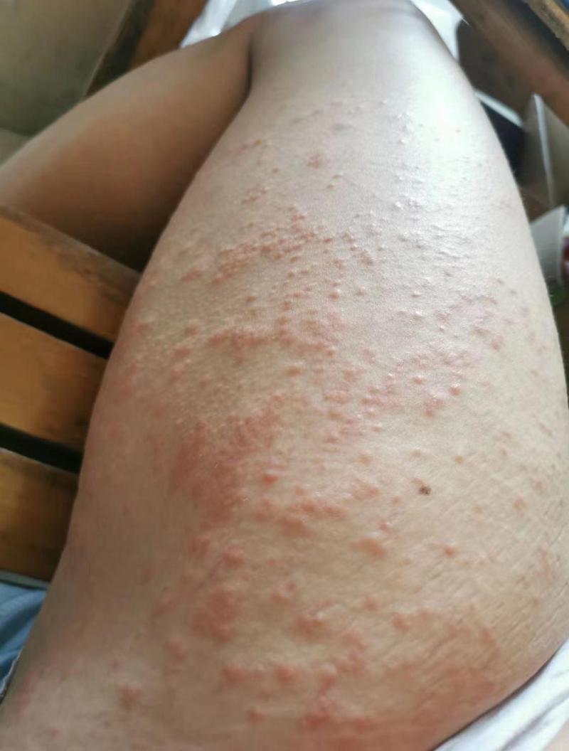 女人大腿痛风湿类风湿