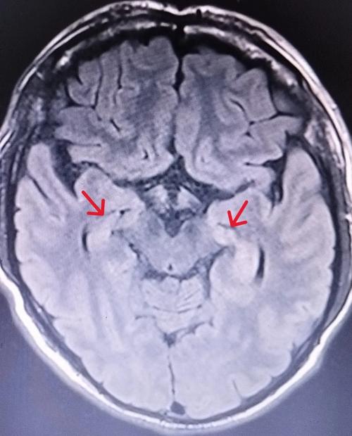 petct能检查脑梗