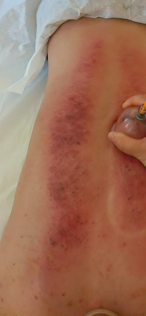 风湿类风湿拔罐的位置