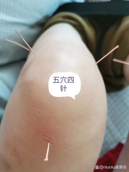 膝盖疼用艾灸什么穴位