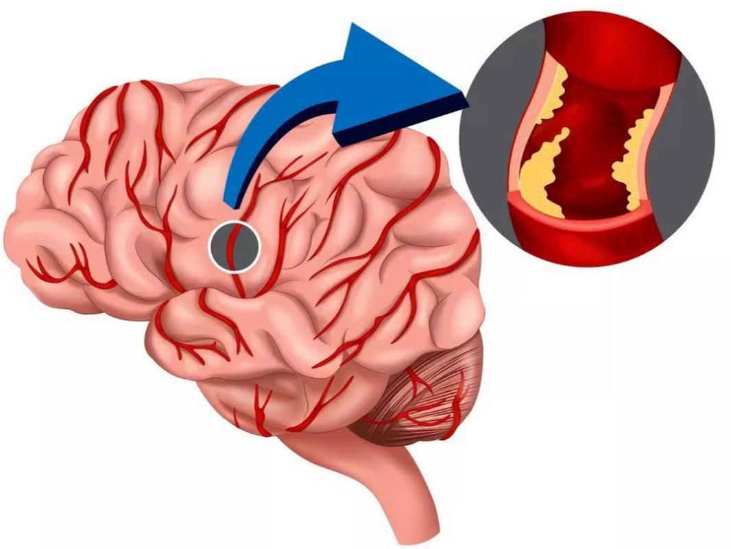 脑梗 血管堵塞65%