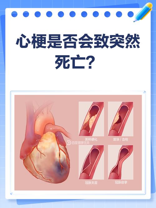 脑梗会引起心梗猝死吗
