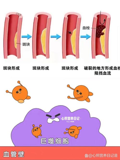 心梗合并脑梗看血小板