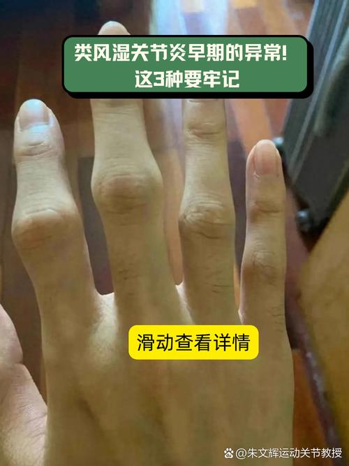 手胀是风湿还是类风湿