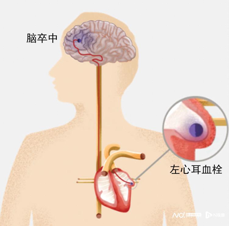 房颤引起脑主动脉脑梗