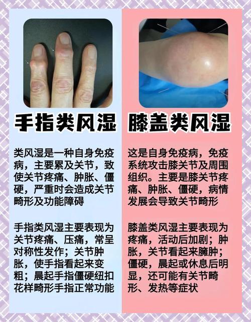 风湿与类风湿脉搏持点