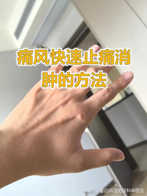 风湿类风湿治疗到前海