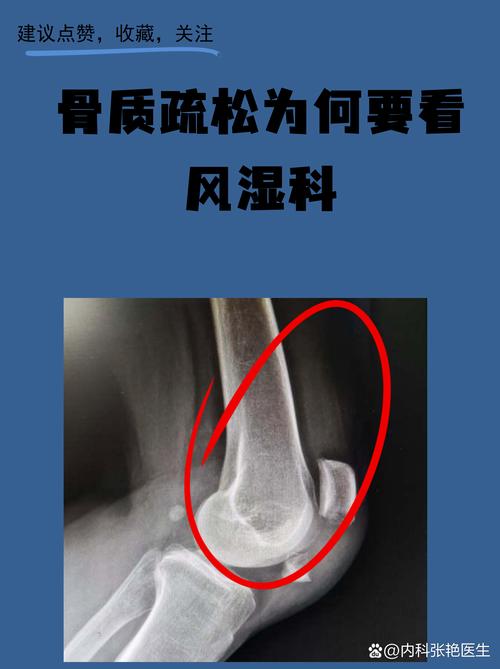 肾病风湿科是风湿科嚒