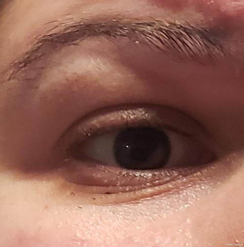 眼皮痉挛 脑梗 昏迷