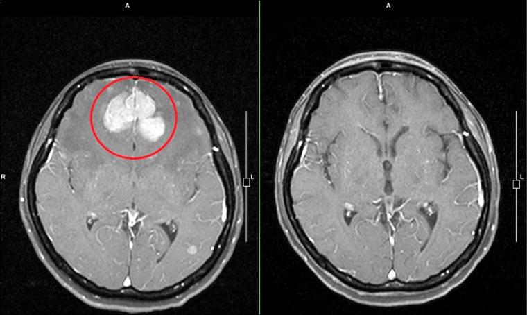 肺腺癌脑转移忽发脑梗