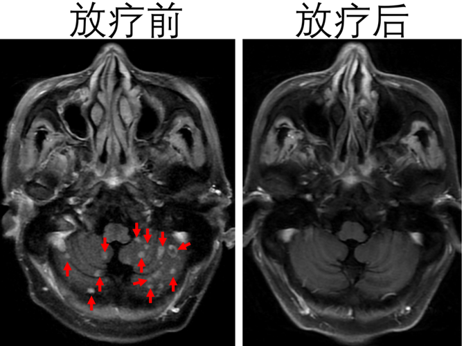 肺腺癌脑转移忽发脑梗