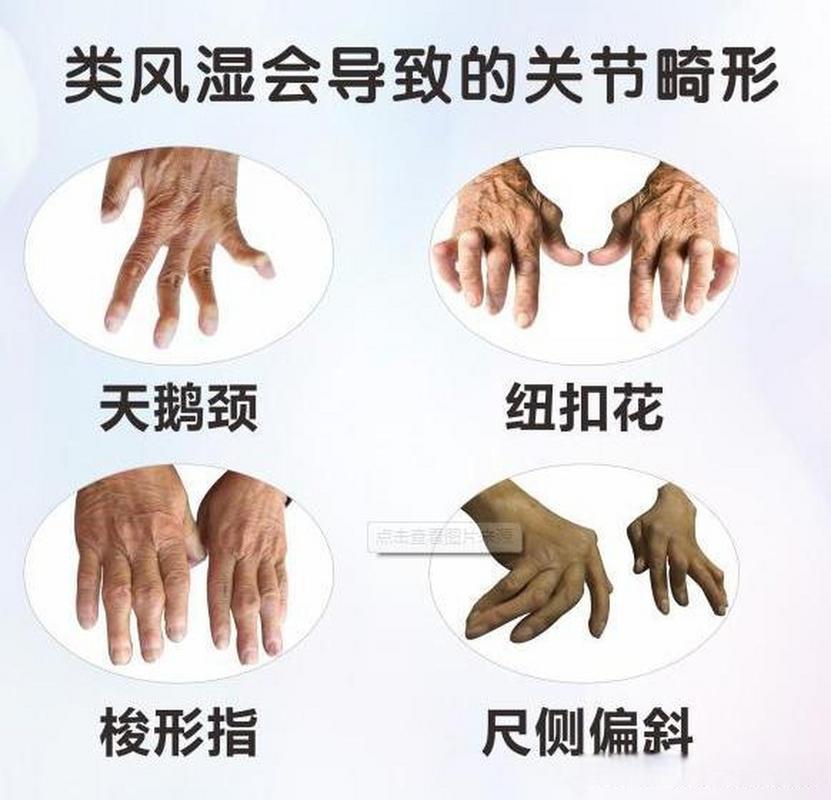风湿类风湿的症状表现