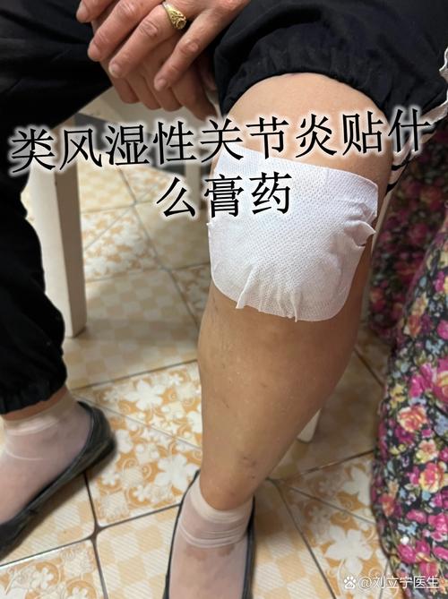 风湿膏药能贴好风湿吗