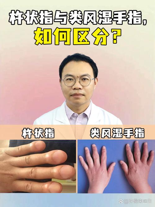 如何判定风湿和类风湿