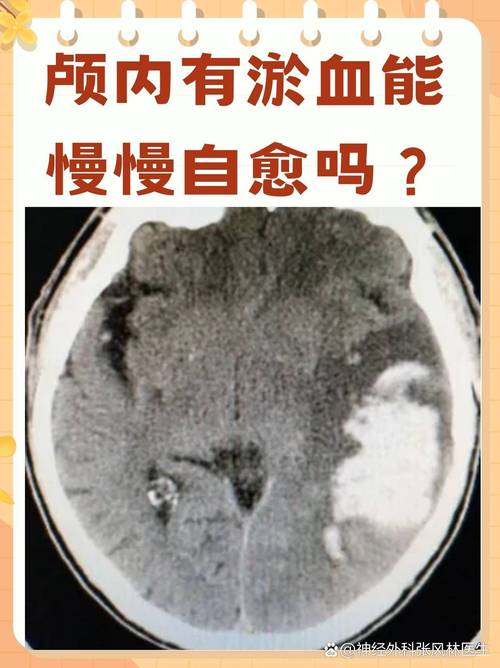 脑梗或者脑淤血的前兆