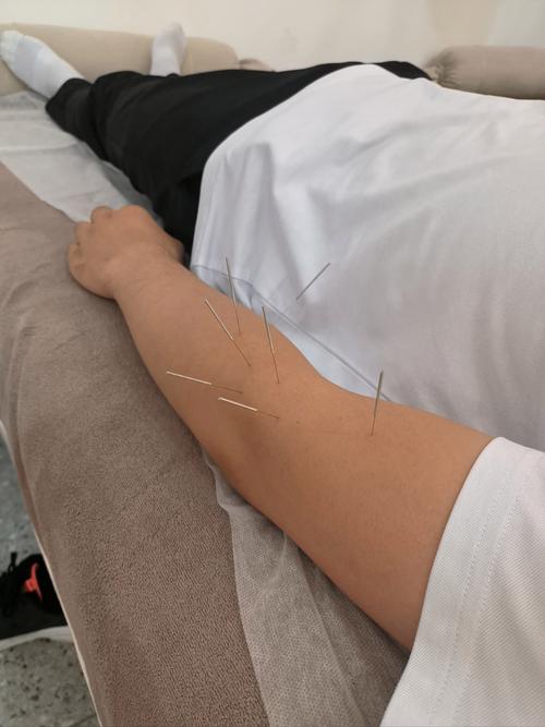 风湿类风湿可以针炙吗