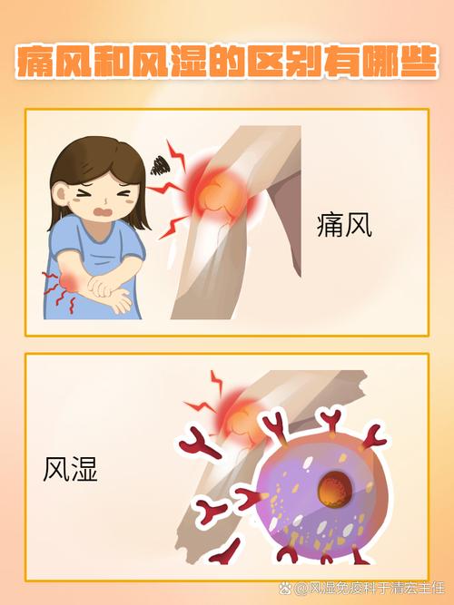 痛风指风湿还是类风湿