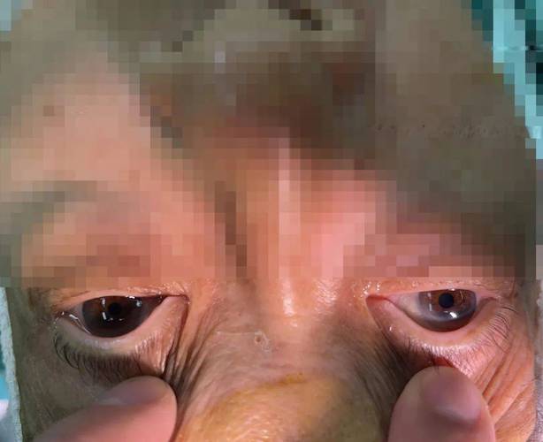 脑梗引发了脑疝手术后