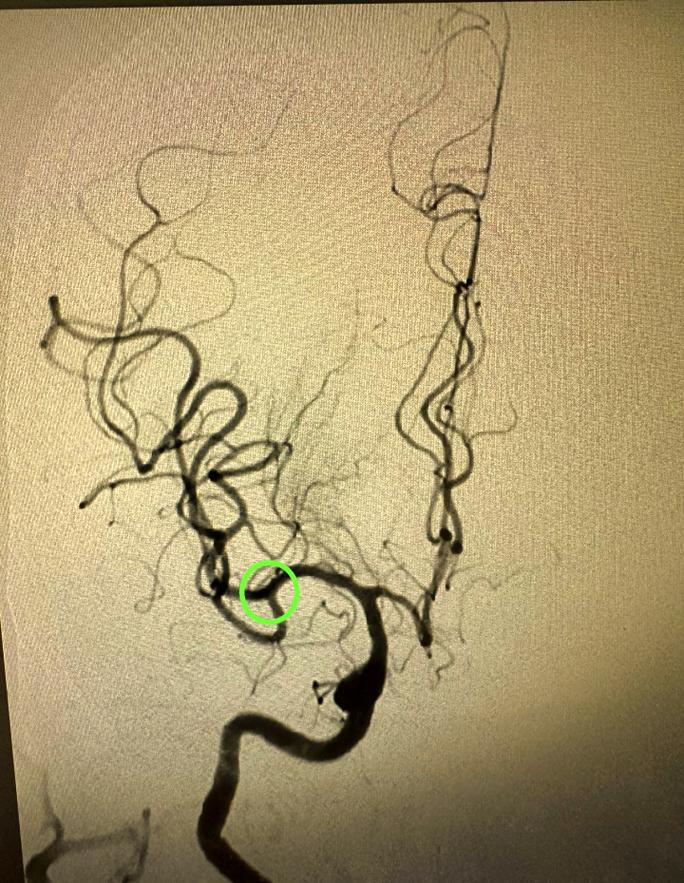 青岛 医院 脑梗堵