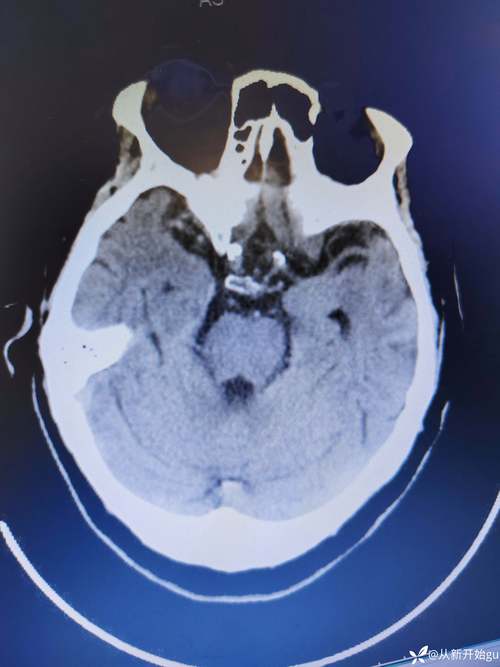 青岛 医院 脑梗堵